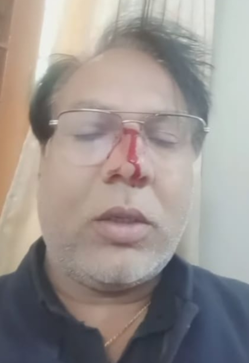 BJP councilor Rohit Sahu and BJP slum cell district president Om Rathod fight over road tender, Rathod suffers serious nose injury, Raipur, Chhattisgarh, Khabargali