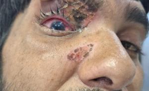 Use of carbide gun should be banned in the state as well: Dr. Dinesh Mishra. Case of eye injury due to carbide gun in Chhattisgarh as well, Raipur, Khabargali, Senior eye specialist of the state Dr. Dinesh Mishra