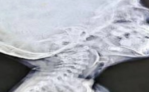 A toy stuck in a child's vocal cords, causing him to stop breathing; doctors' prompt action saved his life. Bemetara news hindi News latest News khabargali 