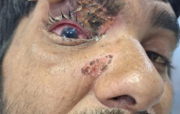 Use of carbide gun should be banned in the state as well: Dr. Dinesh Mishra. Case of eye injury due to carbide gun in Chhattisgarh as well, Raipur, Khabargali, Senior eye specialist of the state Dr. Dinesh Mishra