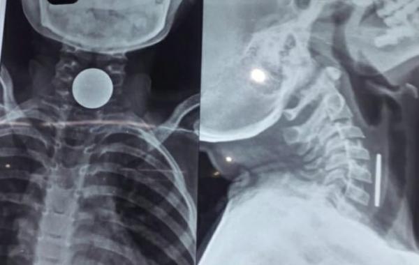 8-year-old boy dies after coin gets stuck in chest, family mourns hindi News latest News big News khabargali 