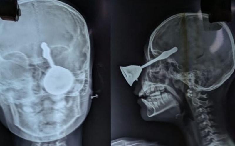 A prayer bell entered a 10-year-old girl's eye; surgery saved her life and caused brain damage. Hindi news latest news khabargali 