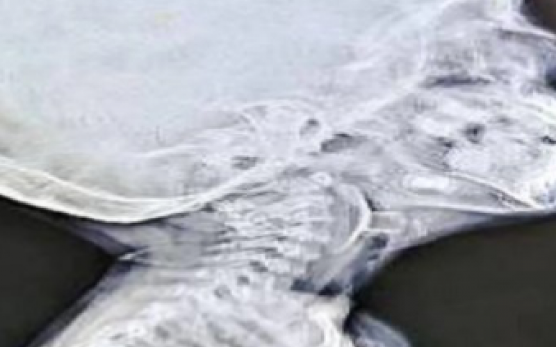 A toy stuck in a child's vocal cords, causing him to stop breathing; doctors' prompt action saved his life. Bemetara news hindi News latest News khabargali 