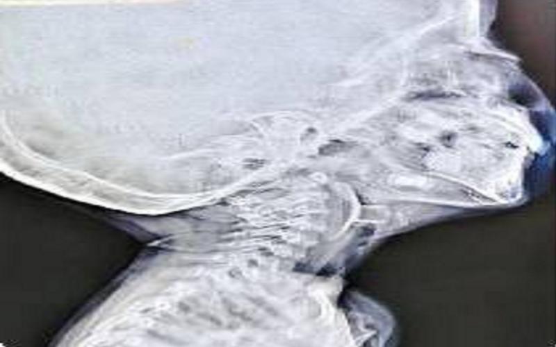 बच्चे के वोकल कॉर्ड में खिलौना फंसने से रुक गई थी सांस, डॉक्टरों की तत्परता से बची जान खबरगली A toy stuck in the child's vocal cords caused the child to stop breathing, and doctors' prompt action saved his life hindi news big news khabargali 