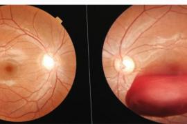 Young man's eye damaged by laser light during immersion procession. High power laser light is harmful for eyes, Dr. Pranjal Mishra, eye and retina specialist of Medical College Raipur, Khabargali