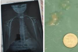 A 5 rupee coin got stuck in the child's throat, his life was in danger, then the doctor became God latest news Chhattisgarh news hindi news big news khabargali 
