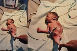 A mermaid-like baby was born in Dhamtari, surprising doctors and nurses; it survived for only three hours. Hindi news big News latest News khabargali 