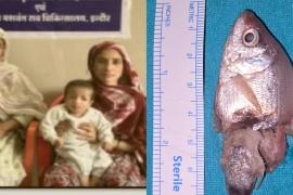 A live fish got stuck in the child's throat, he had put it in his mouth while playing, doctors saved his life. hindi news mp news indore News khabargali