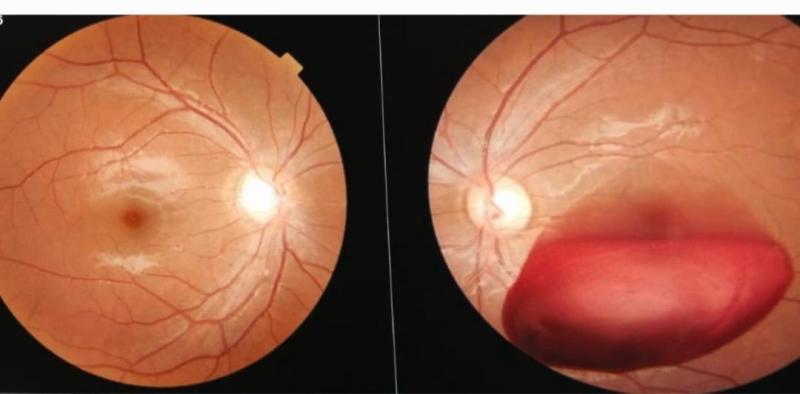 Young man's eye damaged by laser light during immersion procession. High power laser light is harmful for eyes, Dr. Pranjal Mishra, eye and retina specialist of Medical College Raipur, Khabargali