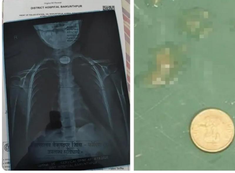 A 5 rupee coin got stuck in the child's throat, his life was in danger, then the doctor became God latest news Chhattisgarh news hindi news big news khabargali 