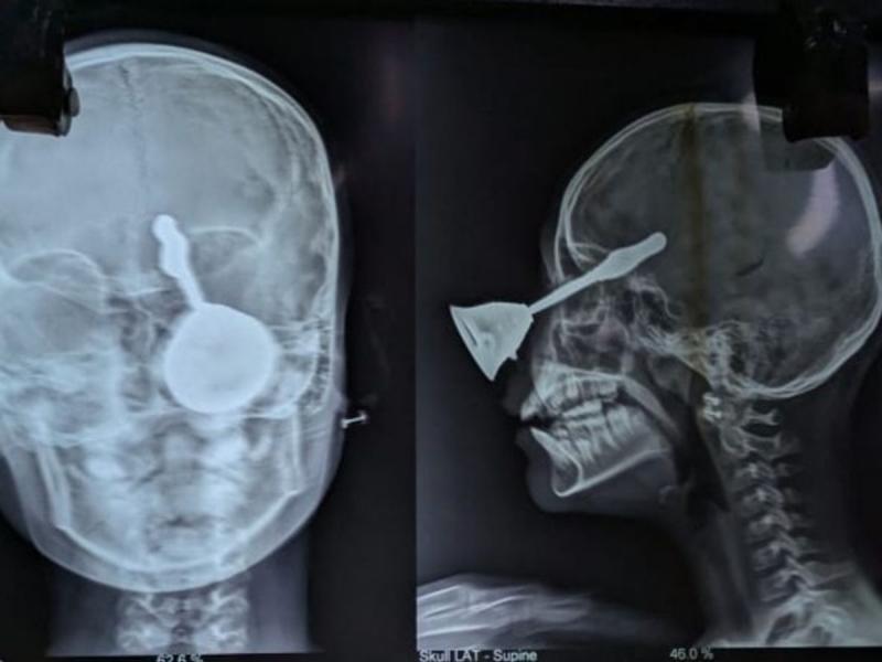 A prayer bell entered a 10-year-old girl's eye; surgery saved her life and caused brain damage. Hindi news latest news khabargali 