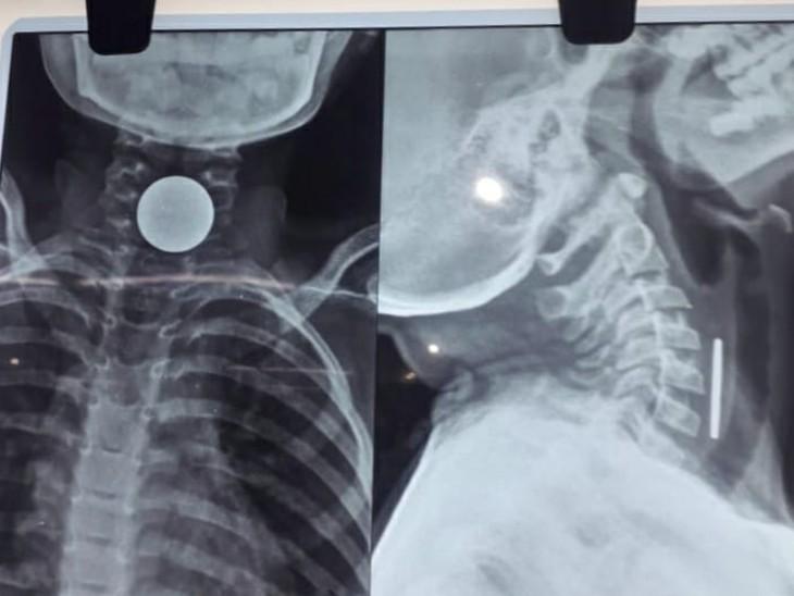 8-year-old boy dies after coin gets stuck in chest, family mourns hindi News latest News big News khabargali 