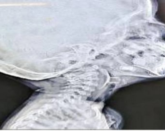 A toy stuck in a child's vocal cords, causing him to stop breathing; doctors' prompt action saved his life. Bemetara news hindi News latest News khabargali 