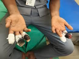 Accident at ITI Doondilhora: Student loses 5 fingers after being hit by a machine big news latest hindi news khabargali 